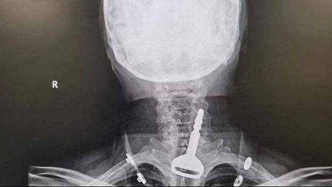 Operasi Laparoskopi Selamatkan Nyawa Pria Saudi yang Menelan Kunci Mobil