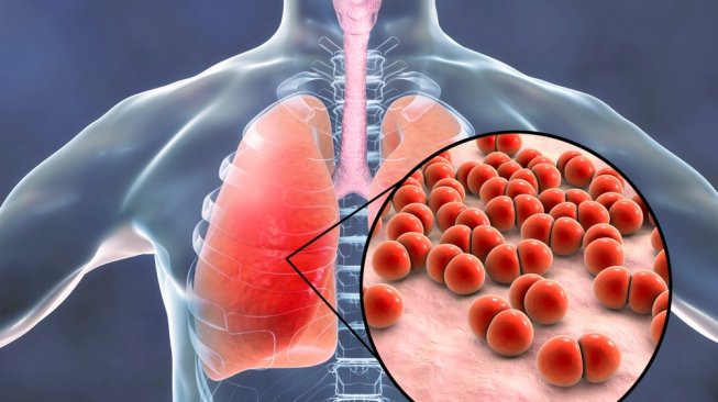 Jangan Lengah, Pakar Ingatkan Ancaman Pneumonia Anak di Tengah Pandemi COVID-19