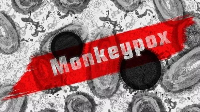 Ada 8 Warga Jakbar Terinfeksi Cacar Monyet, Kasus Terbanyak di Cengkareng