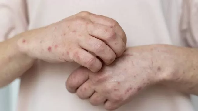 Kasus Pertama Cacar Monyet di Afrika Selatan