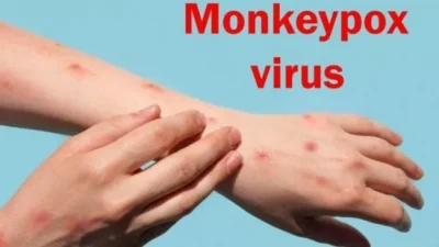 Waspada, Warga Terinfeksi Cacar Monyet di Jakarta Per Hari Ini Capai 13 Kasus